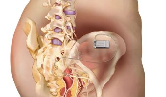 Sacral Neuromodulation Surgery