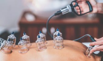 Cupping