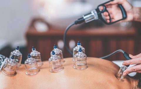 Cupping