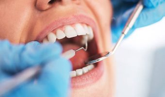 Open female mouth during oral checkup at the dentist. Selective focus.