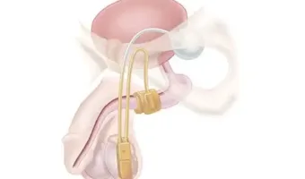 Artificial-Urethral-Sphincter