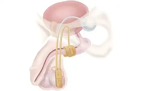 Artificial-Urethral-Sphincter